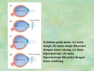 Kelainan pada mata: (a) mata
miopi, (b) mata miopi dikoreksi
dengan lensa cekung, (c) mata
hipermetropi, (d) mata
hipermetropi dikoreksi dengan
lensa cembung.
 