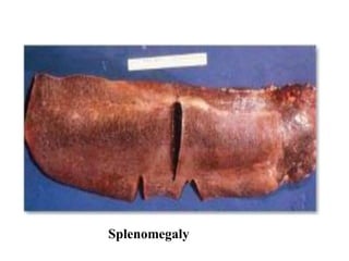 Splenomegaly
 