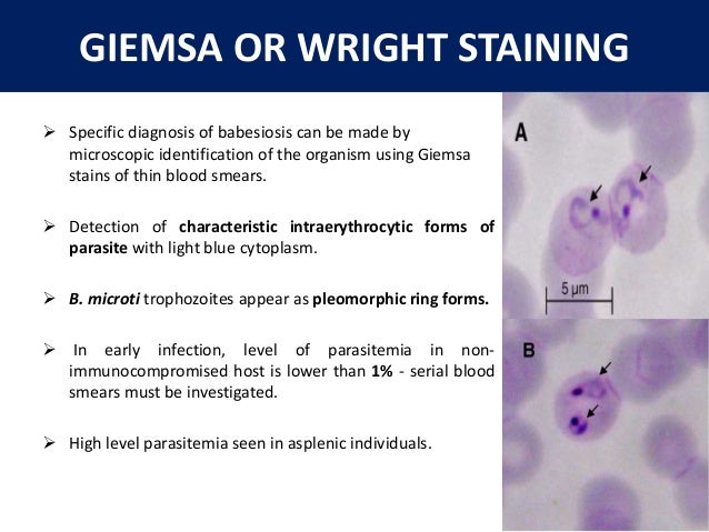 Babesiosis