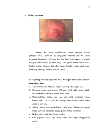 12 
b. Putting susu lecet 
Seorang ibu sering menghentikan proses menyusui karena 
putingnya sakit. Dalam hal ini, yang perlu dilakukan oleh ibu adalah 
mengecek bagaimana perlekatan ibu dan bayi, serta mengecek apakah 
terdapat infeksi candida (di mulut bayi). Jika gejala berikut ditemui, maka 
berikan nistatin. Biasanya, kulit akan merah, berkilat, kadang gatal, terasa 
sakit yang menetap, dan kulit bersisik ( flaky). 
Saat putting susu ibu lecet atau luka, ibu dapat melakukan beberapa 
cara, antara lain: 
a. Terus memberikan ASI pada bagian luka yang tidak begitu sakit. 
b. Mengoles putting susu dengan ASI akhir (hind milk), jangan sekali-kali 
memberikan obat lain, seperti krim, salep. 
c. Mengistirahatkan putting susu yang sakit untuk sementara waktu, 
kurang lebih 1 x 24 jam dan biasanya akan sembuh dalam waktu 
sekitar 2 x 24 jam. 
d. Selama putting susu diistirahatkan, ASI tetap dikeluarkan dengan 
tangan dan tidak dianjurkan dengan pompa karena akan nyeri. 
e. Berikan ASI kepada bayi dengan sendok 
f. Cuci payudara sekali saja dalam sehari dan jangan menggunakan 
sabun. 
 