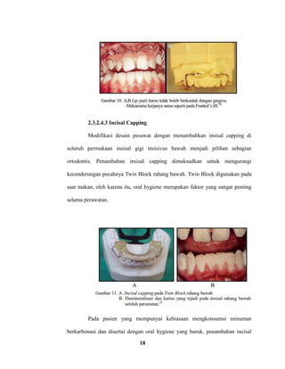 18
2.3.2.4.3 Incisal Capping
Modifikasi desain pesawat dengan menambahkan insisal capping di
seluruh permukaan insisal gigi insisivus bawah menjadi pilihan sebagian
ortodontis. Penambahan insisal capping dimaksudkan untuk mengurangi
kecenderungan pecahnya Twin Block rahang bawah. Twin Block digunakan pada
saat makan, oleh karena itu, oral hygiene merupakan faktor yang sangat penting
selama perawatan.
Pada pasien yang mempunyai kebiasaan mengkonsumsi minuman
berkarbonasi dan disertai dengan oral hygiene yang buruk, penambahan incisal
 