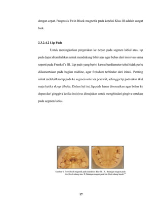 17
dengan cepat. Prognosis Twin Block magnetik pada koreksi Klas III adalah sangat
baik.
2.3.2.4.2 Lip Pads
Untuk meningkatkan pergerakan ke depan pada segmen labial atas, lip
pads dapat ditambahkan untuk mendukung bibir atas agar bebas dari insisivus sama
seperti pada Frankel’s III. Lip pads yang berisi kawat berdiameter tebal tidak perlu
diikutsertakan pada bagian midline, agar frenulum terhindar dari iritasi. Penting
untuk melekatkan lip pads ke segmen anterior pesawat, sehingga lip pads akan ikut
maju ketika skrup dibuka. Dalam hal ini, lip pads harus disesuaikan agar bebas ke
depan dari ginggiva ketika insisivus dimajukan untuk menghindari gingiva tertekan
pada segmen labial.
 