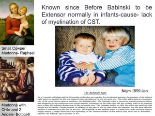 Known since Before Babinski to be
Extensor normally in infants-cause- lack
of myelination of CST.
Small Cowper
Madonna- Raphael
Madonna with
Child and 2
Angels- Botticelli
Nejm 1999 Jan
 