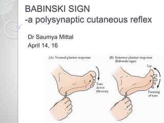 BABINSKI SIGN
-a polysynaptic cutaneous reflex
Dr Saumya Mittal
April 14, 16
 