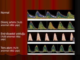 Normal
Direnç artımı (%30
anormal villöz yapı)
End-diyastol yokluğu
(%50 anormal villöz
yapı)
Ters akım (%70
anormal villöz yapı)
 