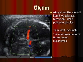 Ölçüm
 Aksiyel kesitte, sfenoid
kemik ve talamus
hizasında, Willis
poligonu görülür
 Tüm MCA izlenmeli
 1-2 mm boyutunda bir
örnek hacmi
kullanılmalı
 