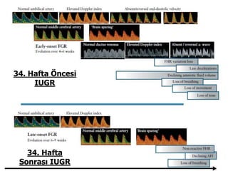 34. Haftadan
önce
34. Hafta Öncesi
IUGR
34. Hafta
Sonrası IUGR
 