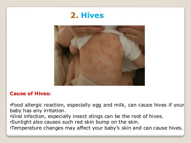 Most Common Skin Rashes In Toddlers