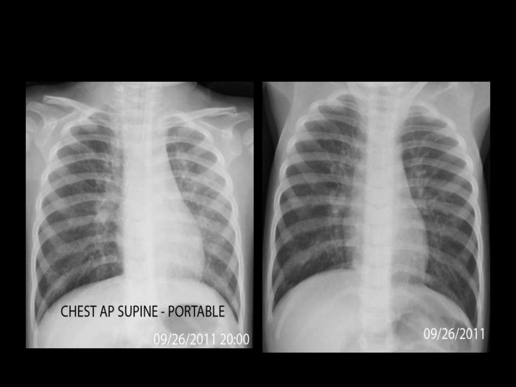 Neonatal Pneumonia