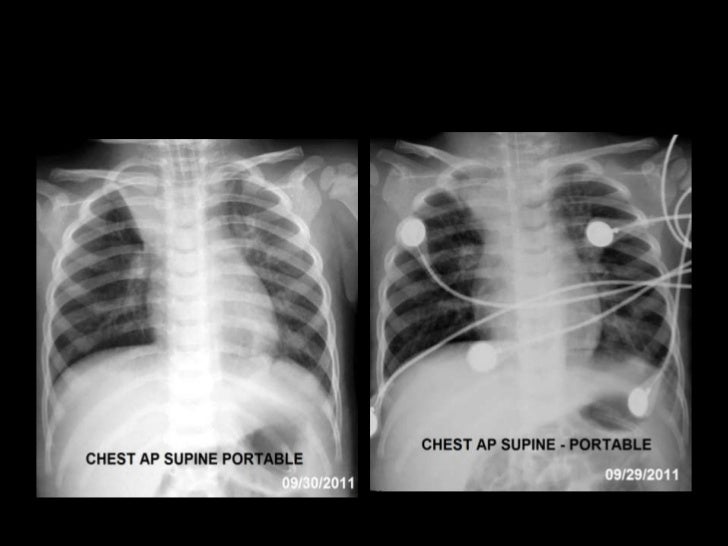 Neonatal Pneumonia