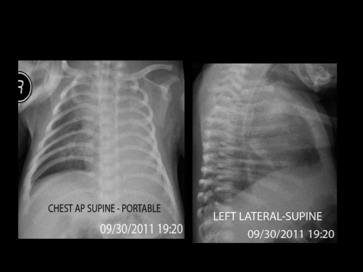 Neonatal Pneumonia