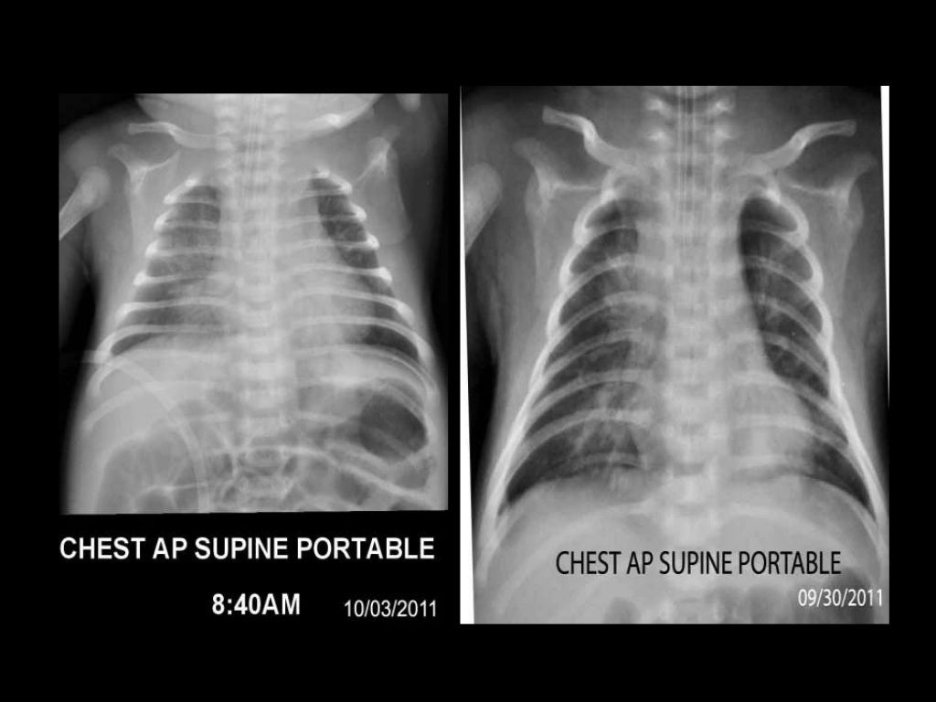 Neonatal Pneumonia