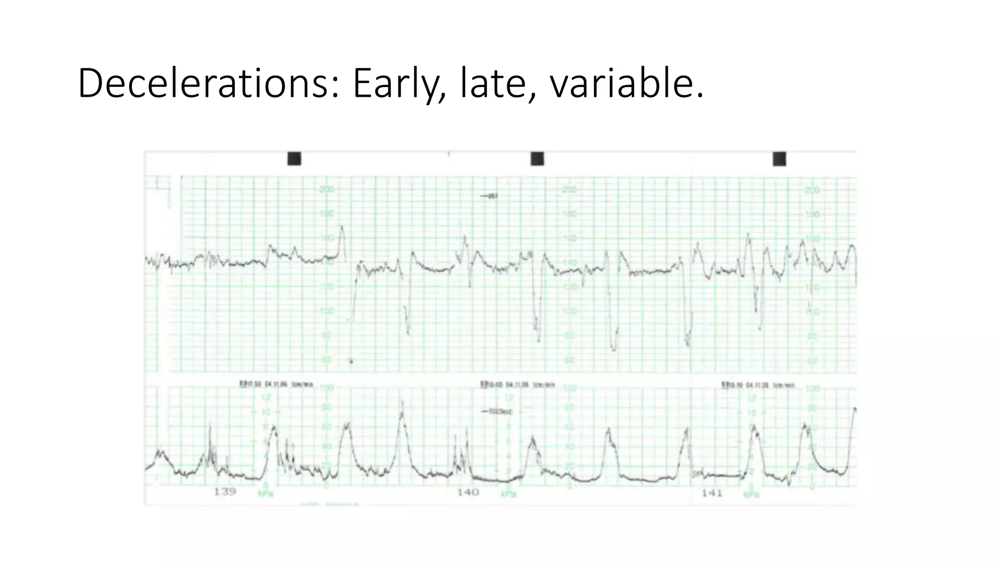 Decelerations: Early, late, variable.