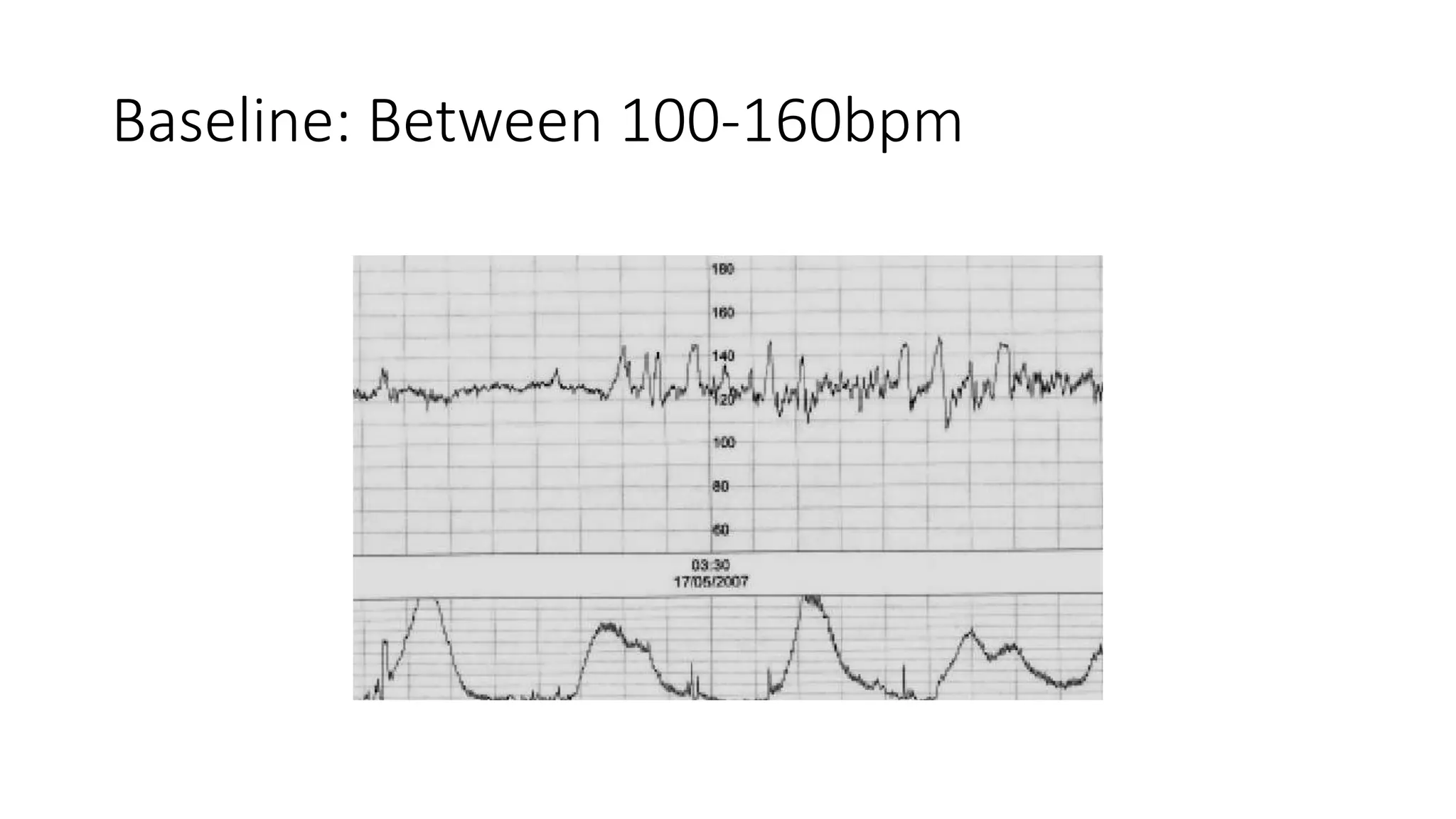 Baseline: Between 100-160bpm