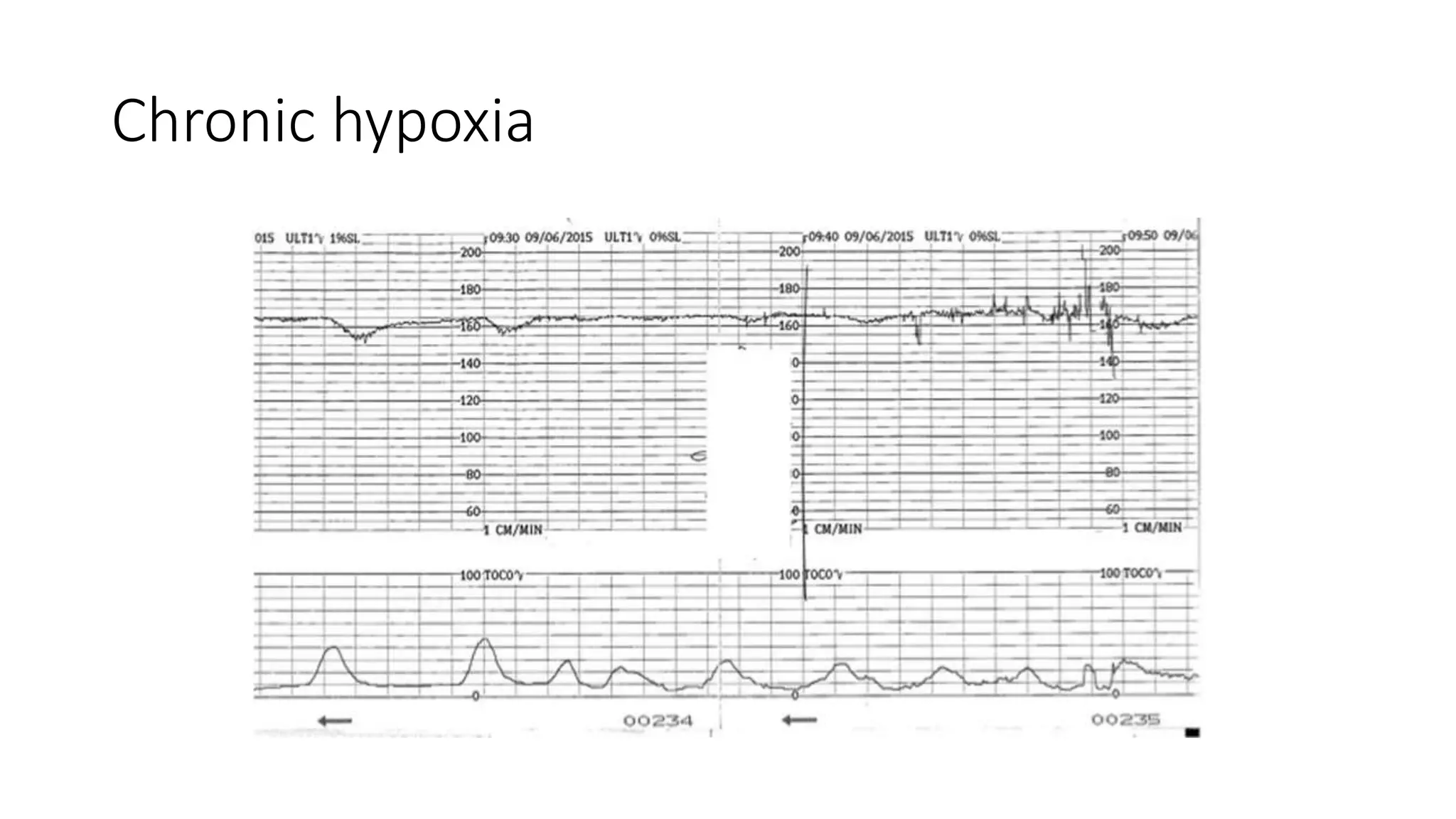 Chronic hypoxia