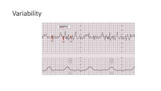 Baby's heart rate | PPTX