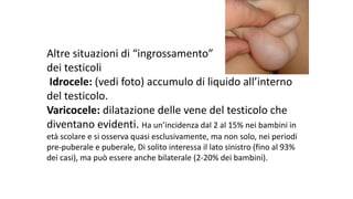 Altre	situazioni	di	“ingrossamento”	
dei	testicoli
Idrocele: (vedi	foto)	accumulo	di	liquido	all’interno	
del	testicolo.	
Varicocele: dilatazione	delle	vene	del	testicolo	che	
diventano	evidenti.	Ha	un’incidenza	dal	2	al	15%	nei	bambini	in	
età	scolare	e	si	osserva	quasi	esclusivamente,	ma	non	solo,	nei	periodi	
pre-puberale	e	puberale,	Di	solito	interessa	il	lato	sinistro	(fino	al	93%	
dei	casi),	ma	può	essere	anche	bilaterale	(2-20%	dei	bambini).
 