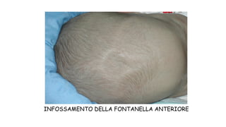 INFOSSAMENTO DELLA FONTANELLA ANTERIORE
 