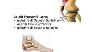 Le più frequenti sono:
• malattia di Osgood-Schlatter:
apofisi tibiale anteriore;
• malattia di Sever o tallonite.
 