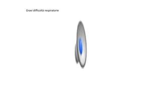 Gravi	difficoltà	respiratorie
 