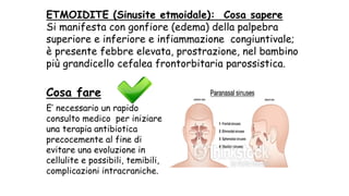 ETMOIDITE (Sinusite etmoidale): Cosa sapere
Si manifesta con gonfiore (edema) della palpebra
superiore e inferiore e infiammazione congiuntivale;
è presente febbre elevata, prostrazione, nel bambino
più grandicello cefalea frontorbitaria parossistica.
Cosa fare
E’ necessario un rapido
consulto medico per iniziare
una terapia antibiotica
precocemente al fine di
evitare una evoluzione in
cellulite e possibili, temibili,
complicazioni intracraniche.
 