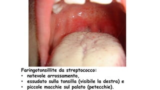 Faringotonsillite da streptococco:
• notevole arrossamento,
• essudato sulla tonsilla (visibile la destra) e
• piccole macchie sul palato (petecchie).
 