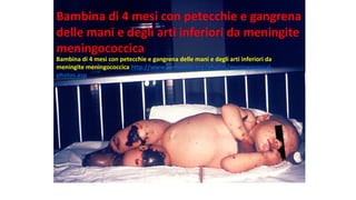 Bambina	di	4	mesi	con	petecchie	e	gangrena	
delle	mani	e	degli	arti	inferiori	da	meningite	
meningococcica	
Bambina	di	4	mesi	con	petecchie	e	gangrena	delle	mani	e	degli	arti	inferiori	da	
meningite	meningococcica	http://www.immunize.org/photos/meningococcal-
photos.asp
 