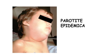 PAROTITE
EPIDEMICA
 