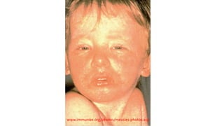 www.immunize.org/photos/measles-photos.asp
 
