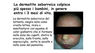 La dermatite seborroica colpisce
più spesso i bambini, in genere
entro i 3 mesi di vita.
La dermatite seborroica del
lattante, meglio nota come
crosta lattea, inizia a
manifestarsi con squame di
color giallastro che si formano
nella zona dei capelli, dietro le
orecchie, sulla fronte, sulle
sopracciglia, sotto le ascelle e
nella zona del pannolino.
 