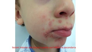 lesioni	intorno	alla	bocca	in	parte	con	infezione	secondaria	
 