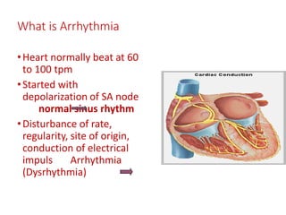 What is Arrhythmia
•Heart normally beat at 60
to 100 tpm
•Started with
depolarization of SA node
normal sinus rhythm
•Disturbance of rate,
regularity, site of origin,
conduction of electrical
impuls Arrhythmia
(Dysrhythmia)
 