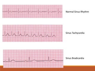 Normal Sinus Rhythm
Sinus Tachycardia
Sinus Bradicardia
 