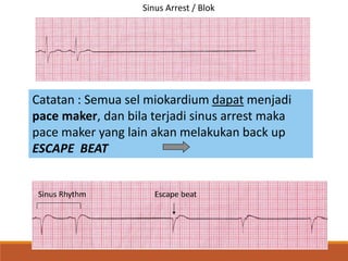 Sinus Arrest / Blok
Catatan : Semua sel miokardium dapat menjadi
pace maker, dan bila terjadi sinus arrest maka
pace maker yang lain akan melakukan back up
ESCAPE BEAT
Sinus Rhythm Escape beat
 