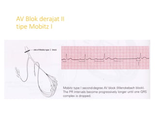 AV Blok derajat II
tipe Mobitz I
 