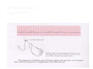 AV Blok derajat II
tipe Mobitz II
 