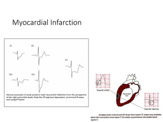 Myocardial Infarction
 