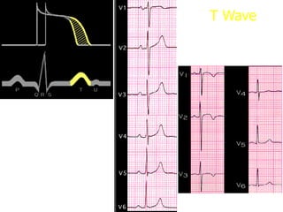 T Wave
 