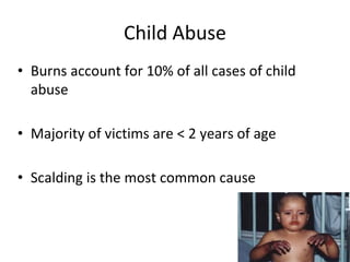 Child Abuse
• Burns account for 10% of all cases of child
abuse
• Majority of victims are < 2 years of age
• Scalding is the most common cause
 