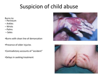 Suspicion of child abuse
Burns to:
– Perineum
– Ankles
– Wrists
– Palms
– Soles
•Burns with clean line of demarcation
•Presence of older injuries
•Contradictory accounts of “accident”
•Delays in seeking treatment
 