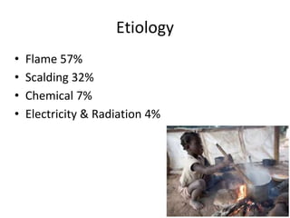 Etiology
• Flame 57%
• Scalding 32%
• Chemical 7%
• Electricity & Radiation 4%
 