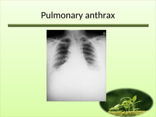 Pulmonary anthrax
 