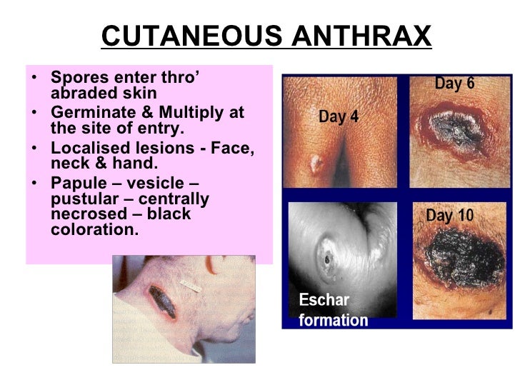 Image Result For Anthrax Image Result For Anthrax