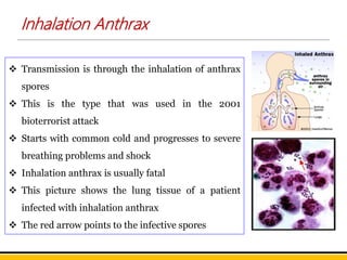  Transmission is through the inhalation of anthrax
spores
 This is the type that was used in the 2001
bioterrorist attack
 Starts with common cold and progresses to severe
breathing problems and shock
 Inhalation anthrax is usually fatal
 This picture shows the lung tissue of a patient
infected with inhalation anthrax
 The red arrow points to the infective spores
Inhalation Anthrax
 