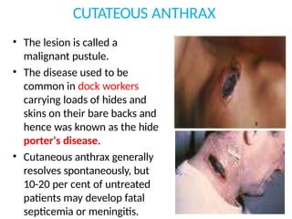 CUTATEOUS ANTHRAX
• The lesion is called a
malignant pustule.
• The disease used to be
common in dock workers
carrying loads of hides and
skins on their bare backs and
hence was known as the hide
porter's disease.
• Cutaneous anthrax generally
resolves spontaneously, but
10-20 per cent of untreated
patients may develop fatal
septicemia or meningitis.
 