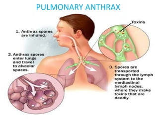 PULMONARY ANTHRAX
 