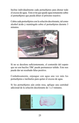 Incline individualmente cada portaobjetos para drenar todo
el exceso de agua. Esto evita que quede agua remanente sobre
el portaobjetos que pueda diluir el próximo reactivo.

Cubra cada portaobjetos con la solución decolorante, tal como
alcohol ácido y manténgalo sobre el portaobjetos durante 3
minutos.




Si no se decolora suficientemente, el contenido del esputo
que no son bacilos TBC puede permanecer teñido. Esto nos
puede dar un resultado falso positivo.

Cuidadosamente, enjuague con agua una vez más los
portaobjetos e inclínelos para quitar el exceso de agua.

Si los portaobjetos aún están rosa, aplique una cantidad
adicional de la solución decolorante de 1 a 3 minutos.




                             25
 