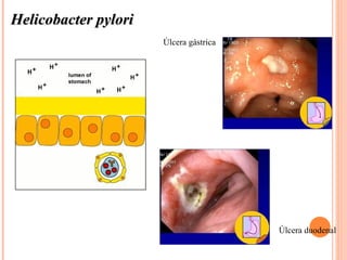 Helicobacter pylori
                      Úlcera gástrica




                                        Úlcera duodenal
 