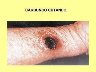 CARBUNCO CUTANEO

 