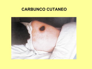 CARBUNCO CUTANEO

 